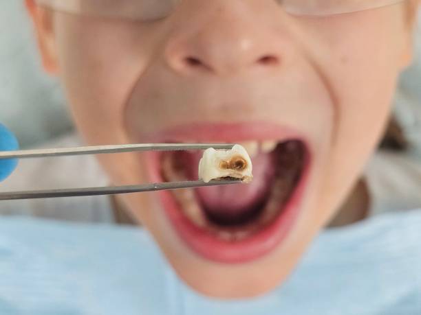 Best Broken or Chipped Tooth Repair in Concord, CA